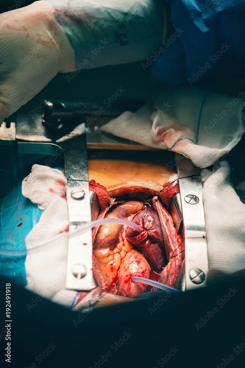 Endoscopic Vessel Harvesting A Less Invasive Path to Heart Surgery